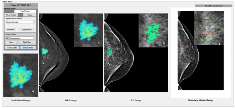 Deep Learning-Based Computer-Aided Diagnosis: Advancing Breast Lesion Classification