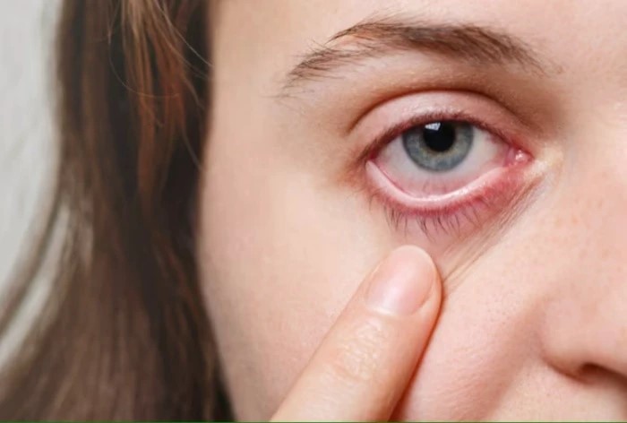 Protecting Eyes Sunburned Eyes Prevention