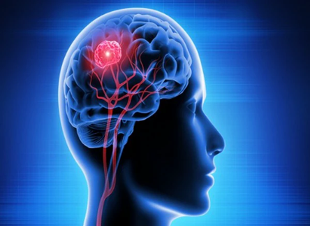 Brain Waves Predict Parkinson’s Impairment